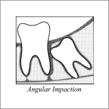 wisdom teeth