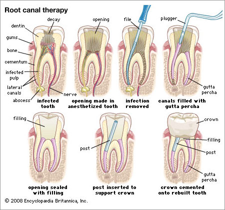 root canal therapy