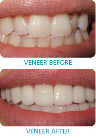 veneers