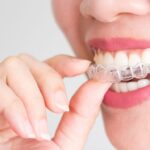 Invisalign