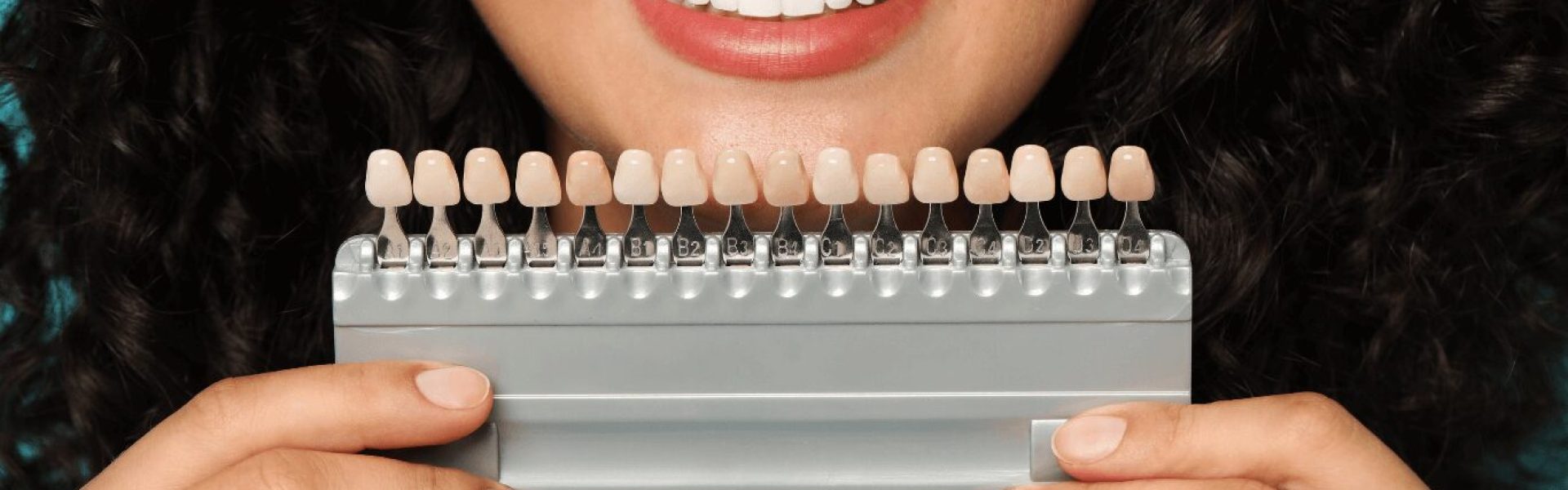 Veneers