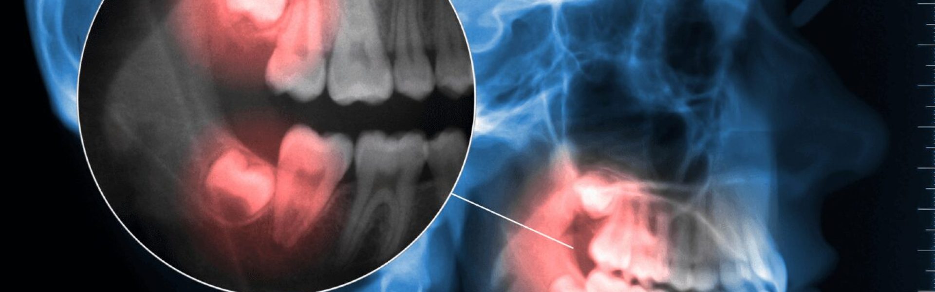 WisdomTooth